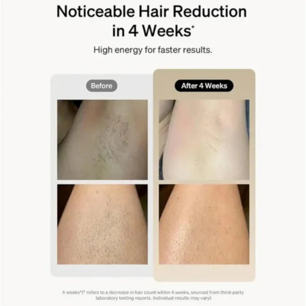 Before and after comparison of hair reduction on a person's leg with text indicating results in 4 weeks, after using IPL hair removal device