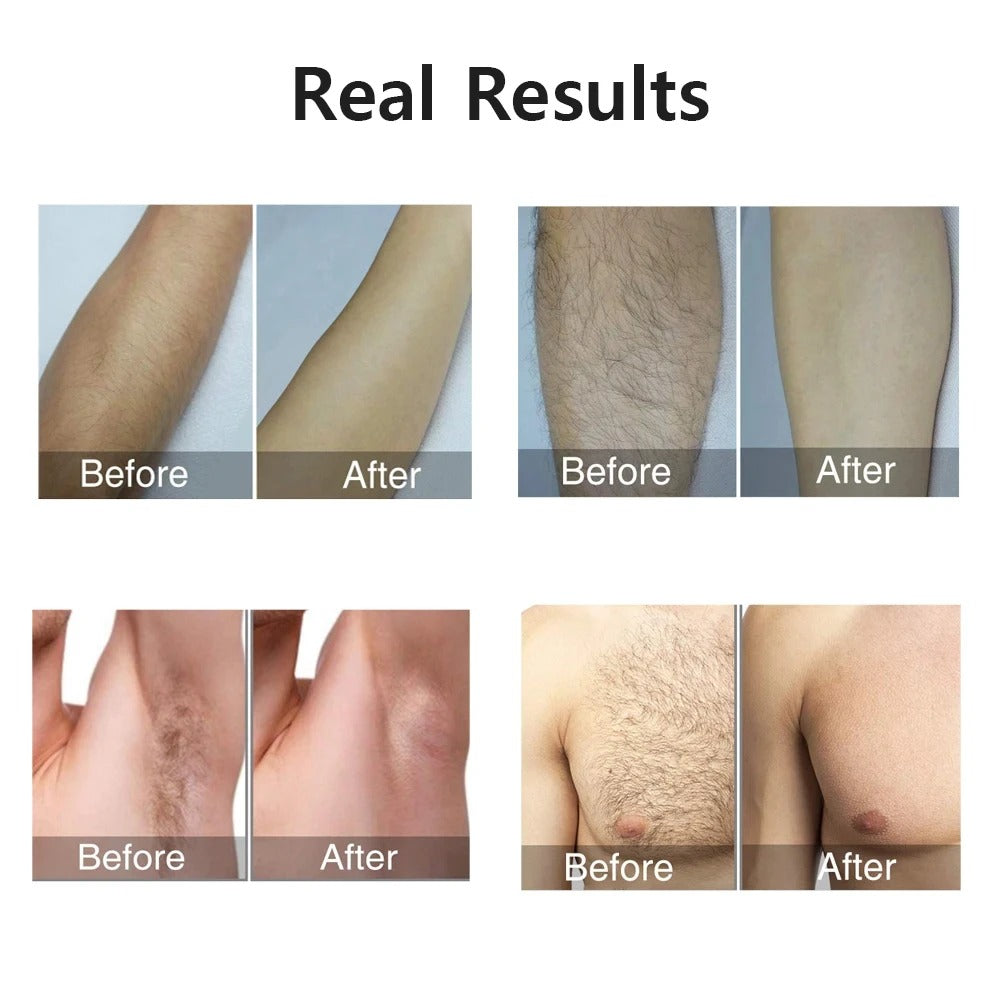 Compact IPL Laser Hair Removal Device – 999,999 Flashes, 5 Energy Levels, Painless Full-Body Treatment