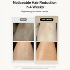 Before and after comparison of hair reduction on a person's leg with text indicating results in 4 weeks, after using IPL light grooming hair removal device
