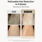 Luxe IPL Laser Hair Removal Device – 900,000 Flashes | Painless Electric Epilator for Face, Body, Bikini & Legs - SMOOVELUXE