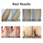 Compact IPL Laser Hair Removal Device – 999,999 Flashes, 5 Energy Levels, Painless Full - Body Treatment - SMOOVELUXE
