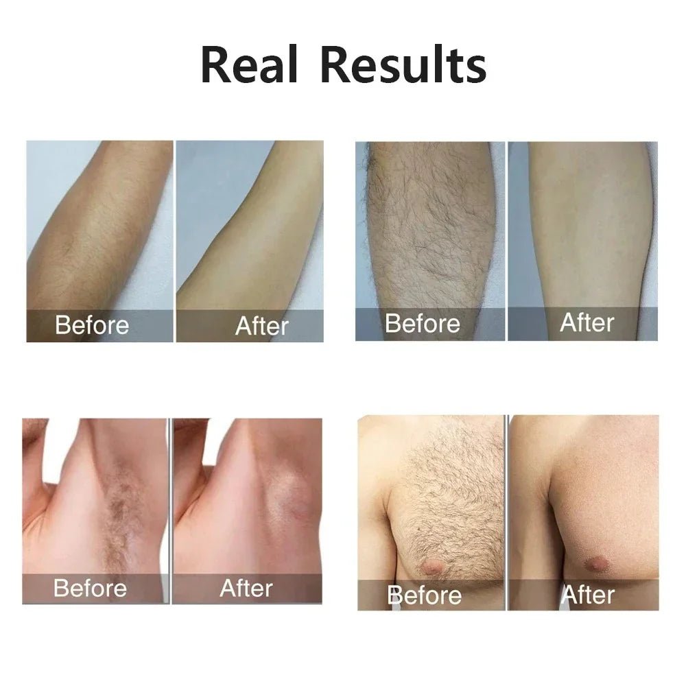 Compact IPL Laser Hair Removal Device – 999,999 Flashes, 5 Energy Levels, Painless Full - Body Treatment - SMOOVELUXE